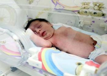Antalya’da 20 bin doğumda bir görülen ‘Ayna’ bebek dünyaya geldi